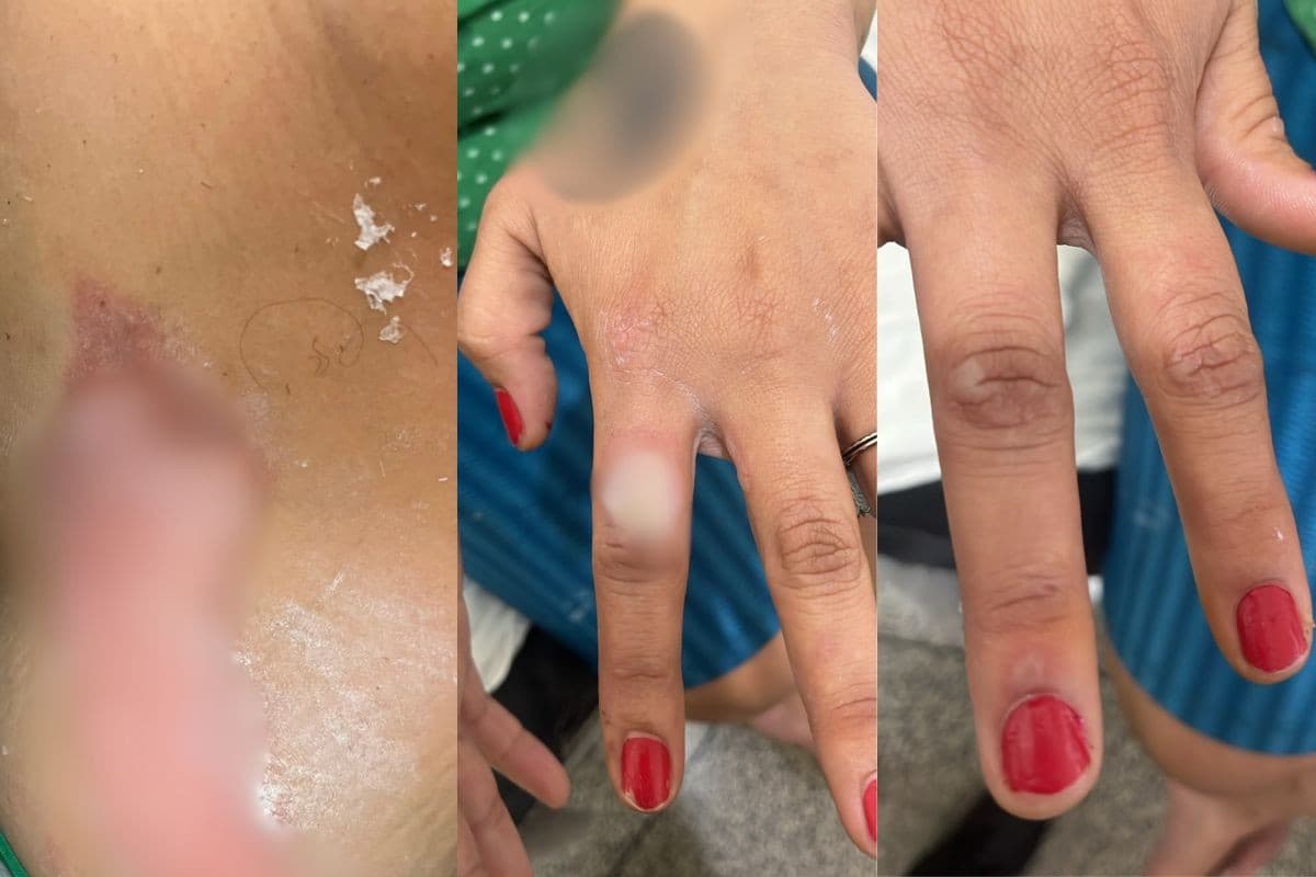 Homem é preso acusado de incendiar companheira por causa de unhas pintadas no PR